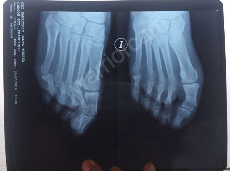 Radiografía del pie fracturado de Francisco Chacón