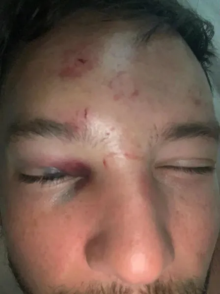 THE SUN Rostro de Drinkwater con heridas