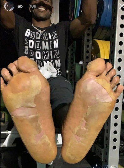 Los pies de Antonio Brown luego de la lesión
