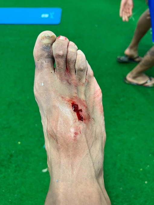 Hazard provocó doble fractura en el pie de Akapo