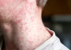 CDMX alerta por aumento de sarampión: ¿quiénes deben vacunarse ya?