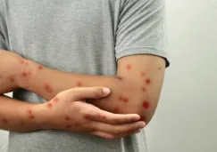 Sarampión en México: Reportan aumento de casos en diciembre ¿Cuáles son los síntomas?