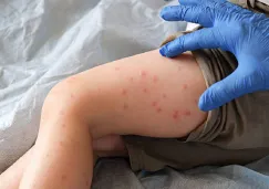 Alerta en México por brote de sarampión: Síntomas, cómo prevenir la enfermedad y estados con más casos