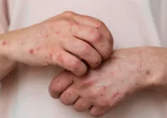 Recuerda que la vacunación puede detener los casos reportados en los estados.