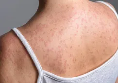 ¿Estás en riesgo por el sarampión? Esto dice la UNAM sobre adultos mayores y vacunación ¿Estás en riesgo por el sarampión? Esto dice la UNAM sobre adultos mayores y vacunación