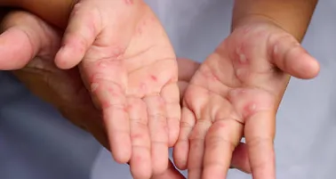 Suspenden festejos de Día de Muertos por brote del virus Coxsackie