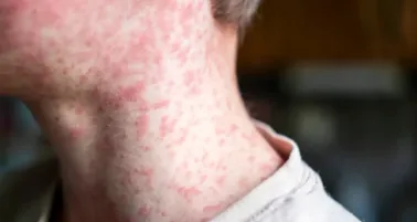 CDMX alerta por aumento de sarampión: ¿quiénes deben vacunarse ya?