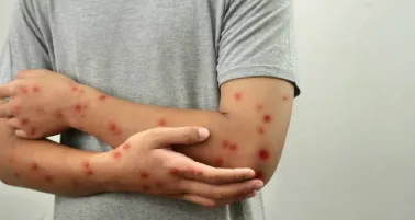 Sarampión en México: Reportan aumento de casos en diciembre ¿Cuáles son los síntomas?