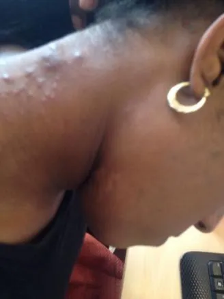 ESPECIAL La alergía le estaba causando la aparición de ronchas en la piel