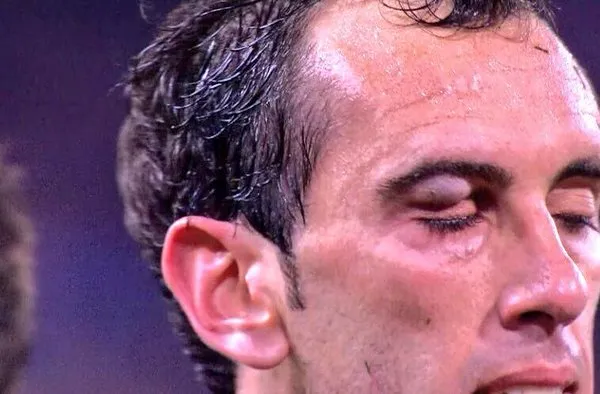 ESPECIAL Así quedó el rostro de Godín tras el codazo de Suárez