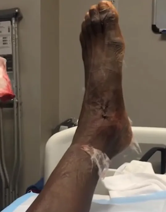 INSTAGRAM @J.MARTINEZOFFICIAL El pie de Jackson Martínez tras la operación del 2017