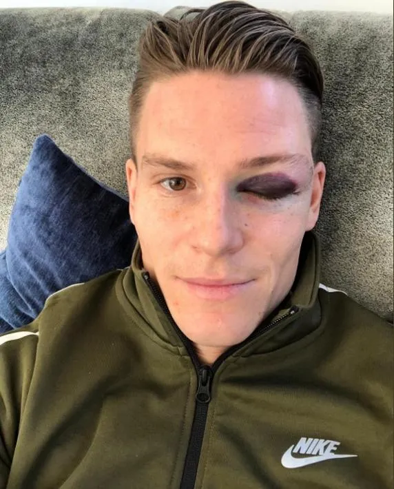 TWITTER @kevingameiro9 Fotografía de Gameiro con golpe en el ojo