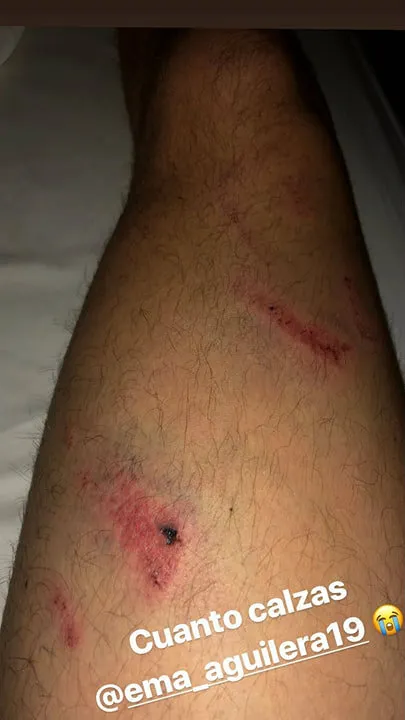 Pierna de Marchesín con algunas huellas del choque