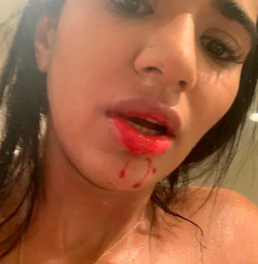 Daniela Cortés muestra sus heridas