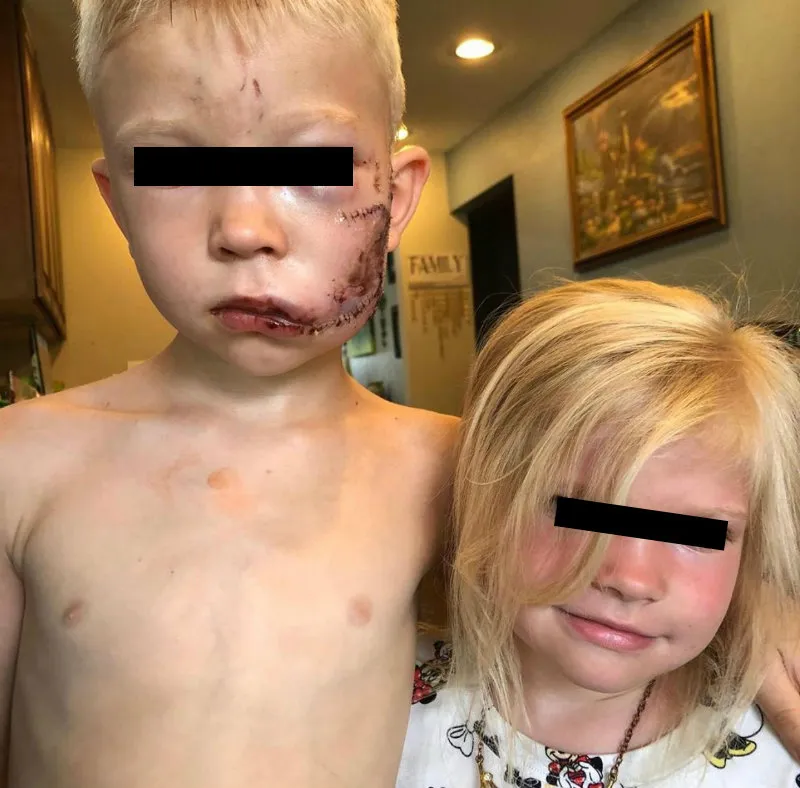 Bridger Walker y su hermana después del ataque del perro