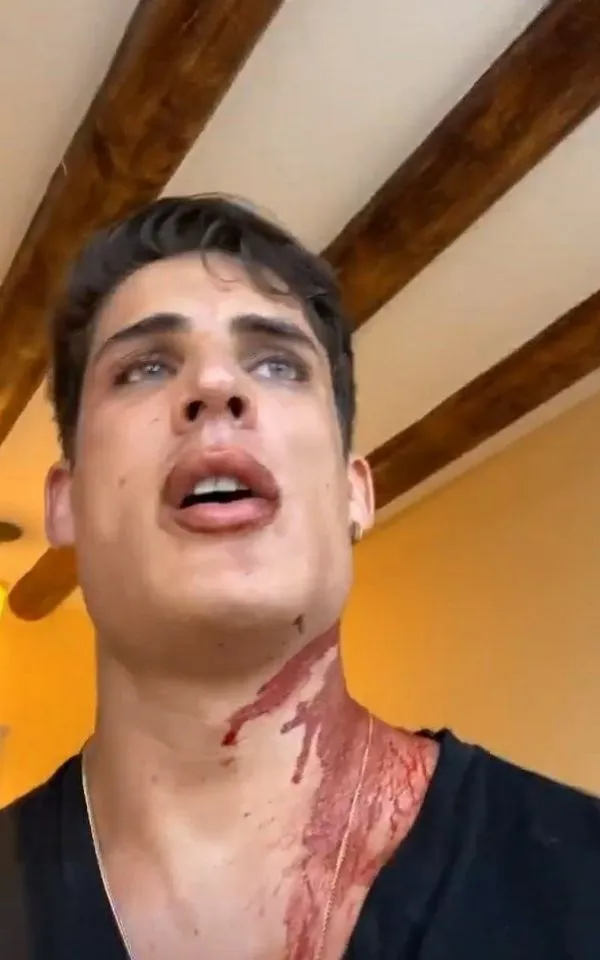 ESPECIAL Tiago Ramos mostró las heridas que sufrió