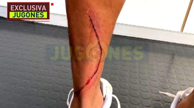 TWITTER:@ELCHIRINGUITOTV Lesión de Marvin Park