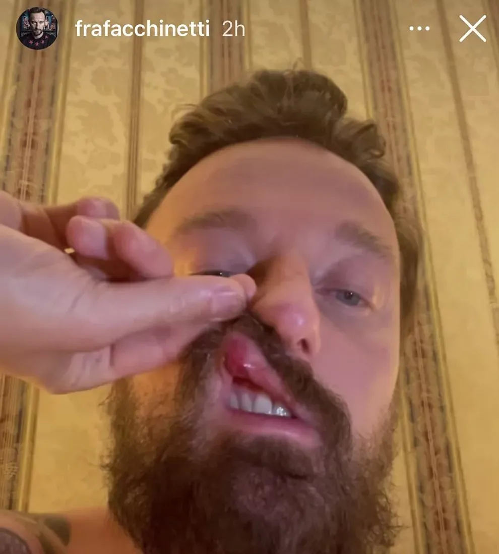 Francesco Facchinetti mostrando sus heridas