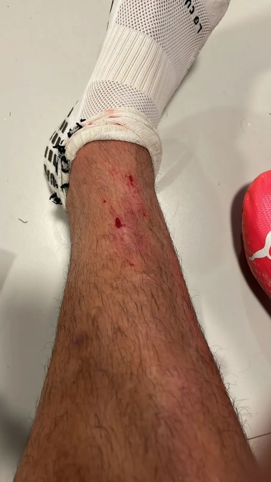 Herida de Juan Ignacio Dinenno en la espinilla de la pierna derecha