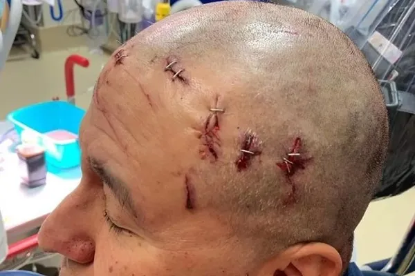 Árbitro Lando Deltoro tras el ataque