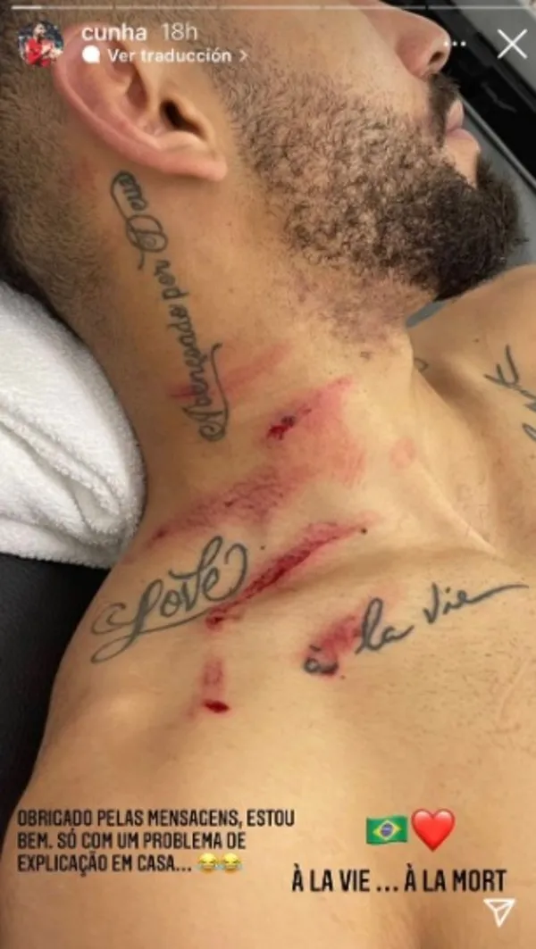 INSTAGRAM @cunha Matheus Cunha exhibió sus heridas en el cuello tras el Brasil vs Ecuador