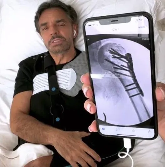 Eugenio Derbez muestra como se le rompió el hombro