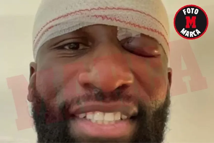 Rostro de Rüdiger tras el golpe