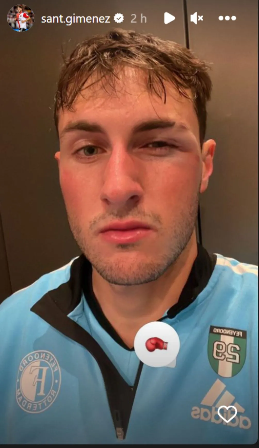 Santi lució con el ojo izquierdo golpeado