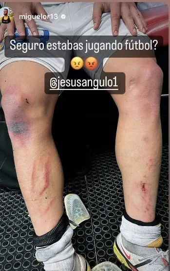 Así quedaron las piernas del jugador de los Tigres
