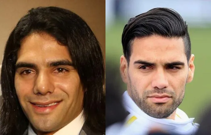 El cambio de Radamel Falcao antes y después del quirófano