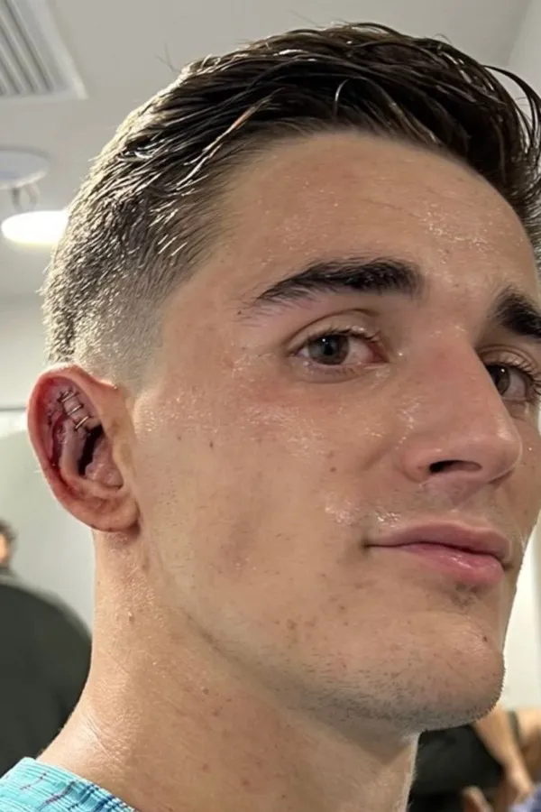 CAPTURA DE PANTALLA: INSTAGRAM Herida de Gavi en partido del Barcelona