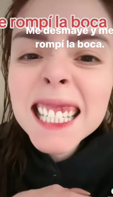 La grafóloga mostró cómo el golpe en la cara afectó su dentadura.