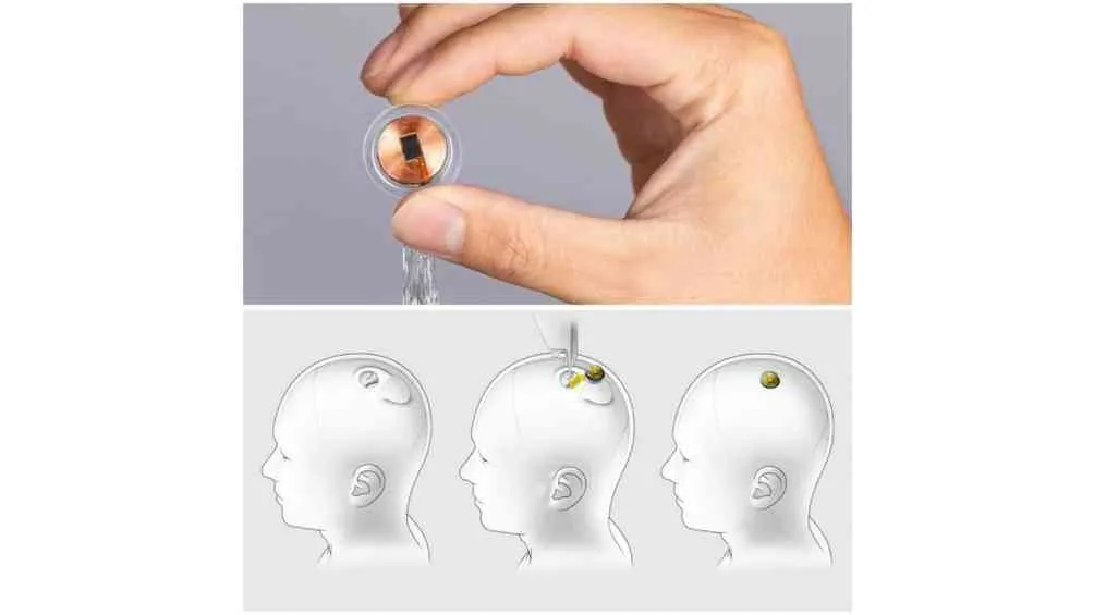 El chip implantado contiene 64 hilos flexibles, más finos que un cabello.