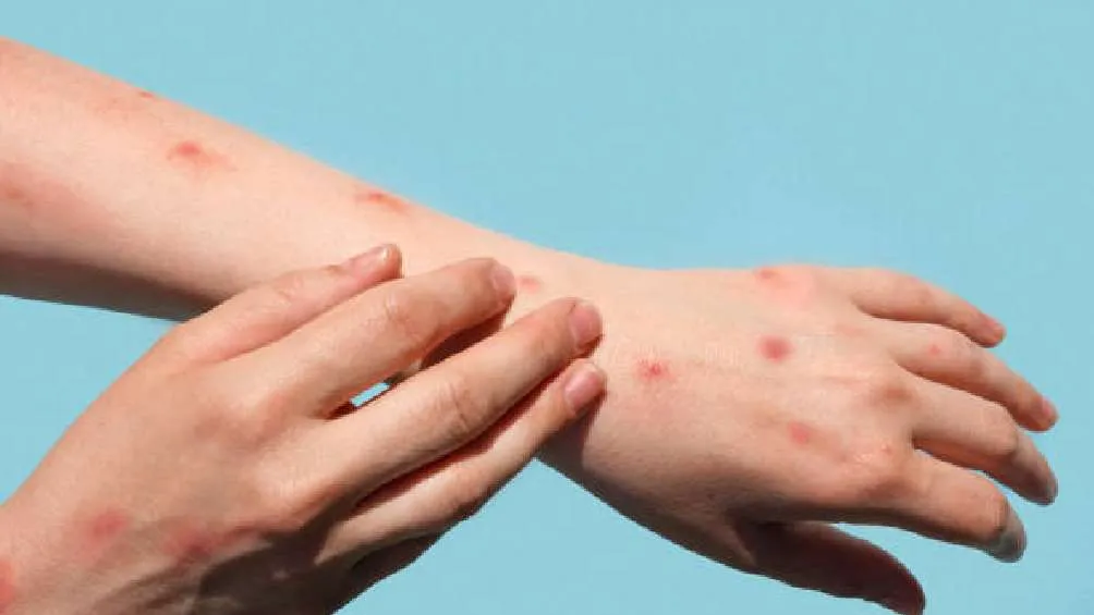 El hombre murió a finales de enero víctima de la viruela de Alaska.