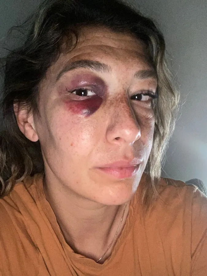 Así quedó Mónica Alvarado tras el codazo