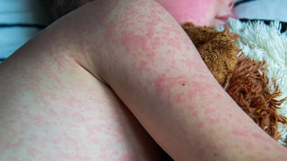 El sarampión es una enfermedad viral altamente contagiosa que afecta principalmente a niños y se caracteriza por fiebre, erupción cutánea y síntomas respiratorios Foto iStock