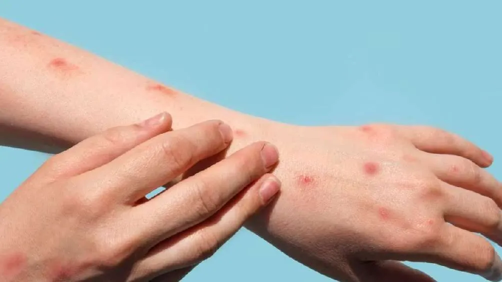 Pixabay El sarampión es una enfermedad de fácil contagio.