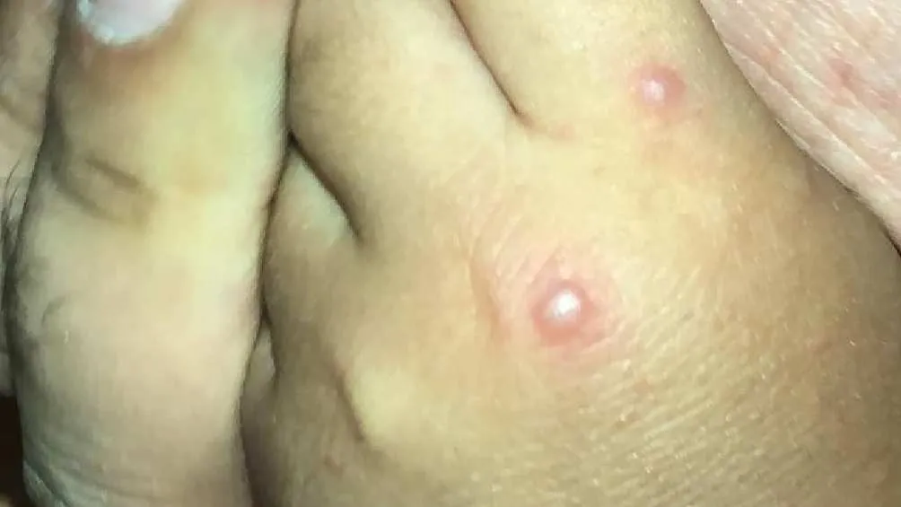 El principal síntoma de la enfermedad son llagas en manos, pies y boca.