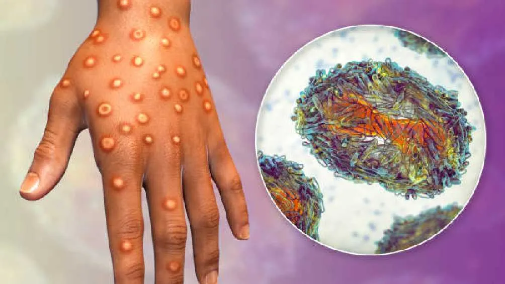 La OMS declaró emergencia epidemiológica por esta enfermedad.