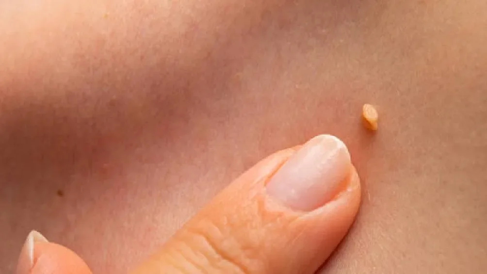 Algunos de los síntomas que presenta el VPH son la aparición de verrugas en zonas genitales.