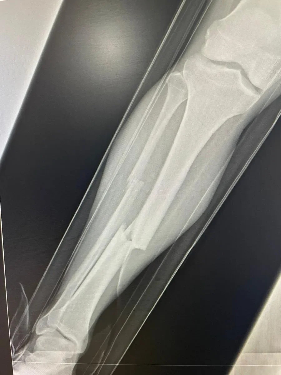 Así fue la fractura que sufrió Bermúdez