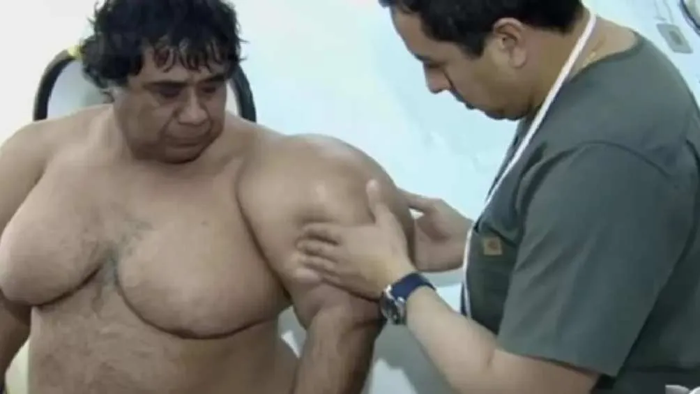 X Brazos, hombros, pecho y abdomen del hombre han quedado deformados.