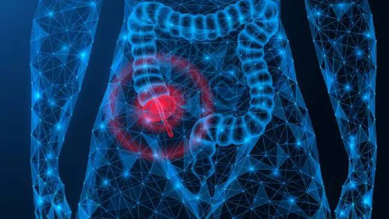 La apendicitis es la inflamación del apéndice, un pequeño órgano ubicado en la parte inferior derecha del abdomen/ Pixabay