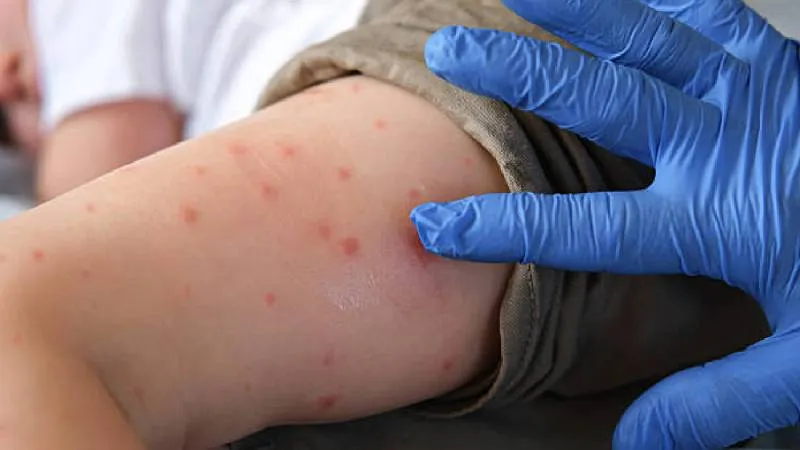 La UNAM explica que muchos adultos mayores podrían contar con defensa natural contra el sarampión, según su año de nacimiento./ Pixabay