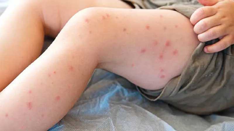 La vacuna triple viral es segura en adultos y se recomienda revisar el esquema ante brotes de sarampión en México./Pixabay