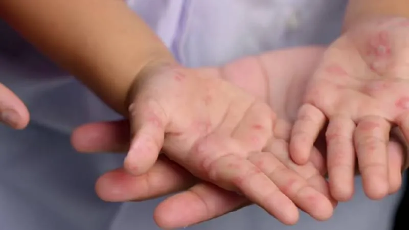 Autoridades de salud recomiendan verificar la cartilla de vacunación para confirmar la protección contra el sarampión./ Pixabay