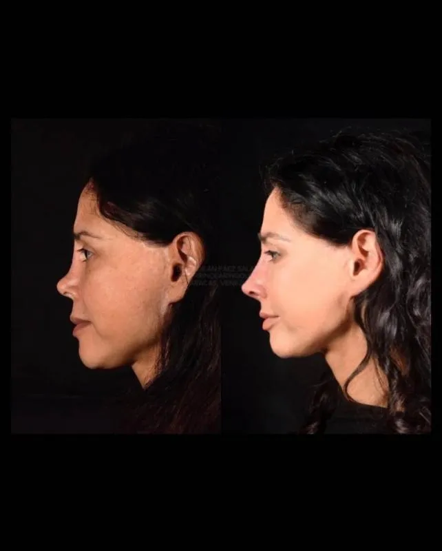 Proceso de recuperación de la nariz de Dorismar documentado en redes sociales. / @dorismartv