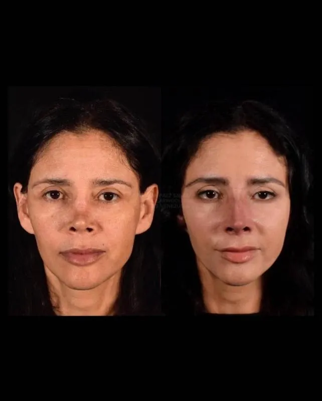 La actriz argentina comparte imágenes del antes y después luego de una mala cirugía estética. / @dorismartv