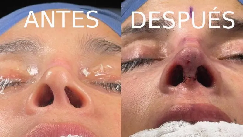 La modelo se sometió a una reconstrucción de nariz en Colombia/IG: @dorismartv