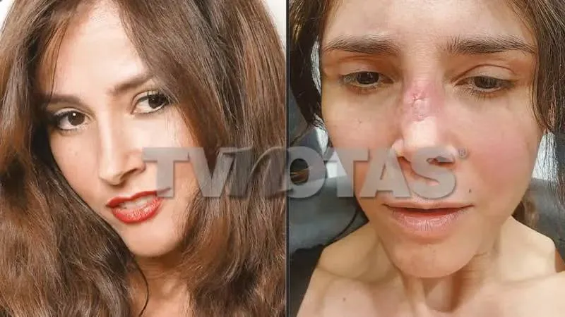 Dorismar sufrió una mala praxis que la dejó con el rostro desfigurado/TVNotas